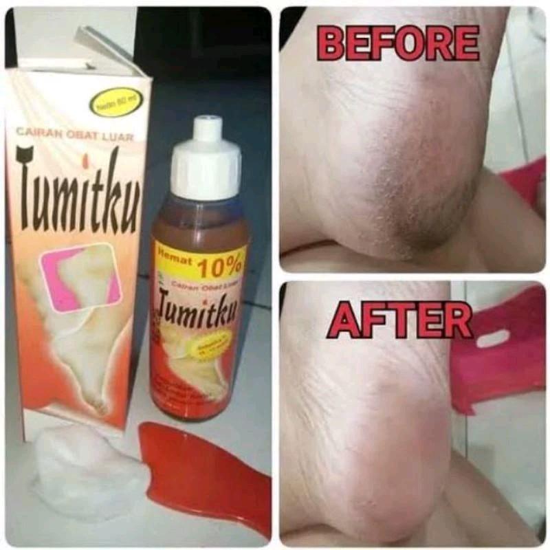 TUMITKU / TUMIT KU UNTUK KAKI PECAH PECAH 3