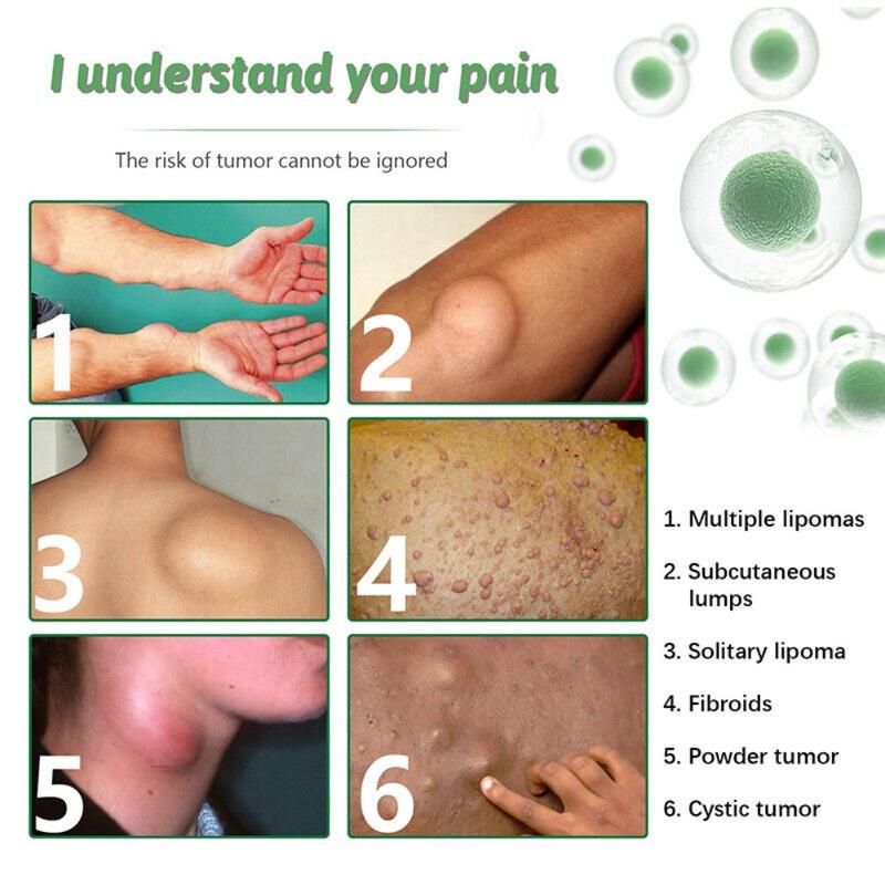 Product Introduction of Body Sticker Anti-Swelling Lipoma Removal Cream Treatment Fat Knot Repair Patch Body Treatment Patch Cellulite Remove Plaster Skin Swelling Antitumor Repair Patch 14