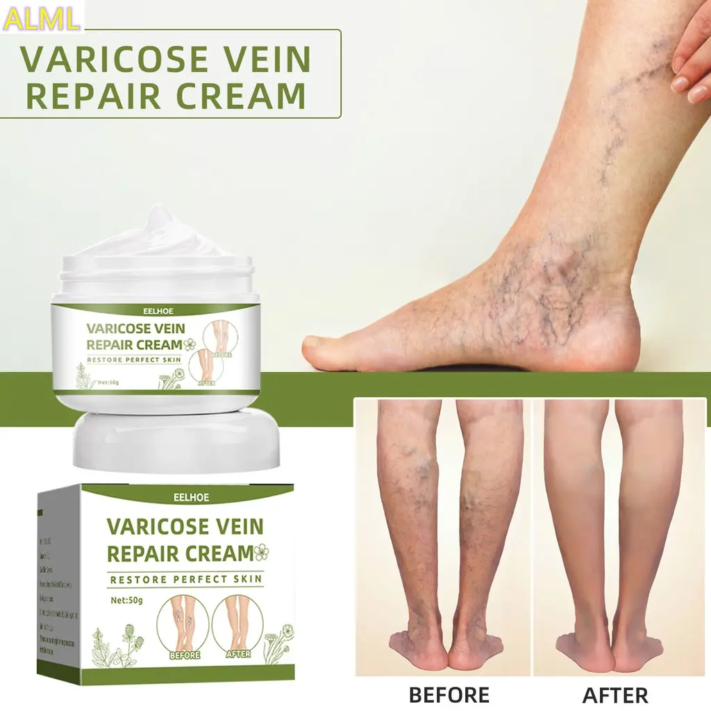 Treatment of varicose veins leg cream worm swelling pain veins red blood spider silk