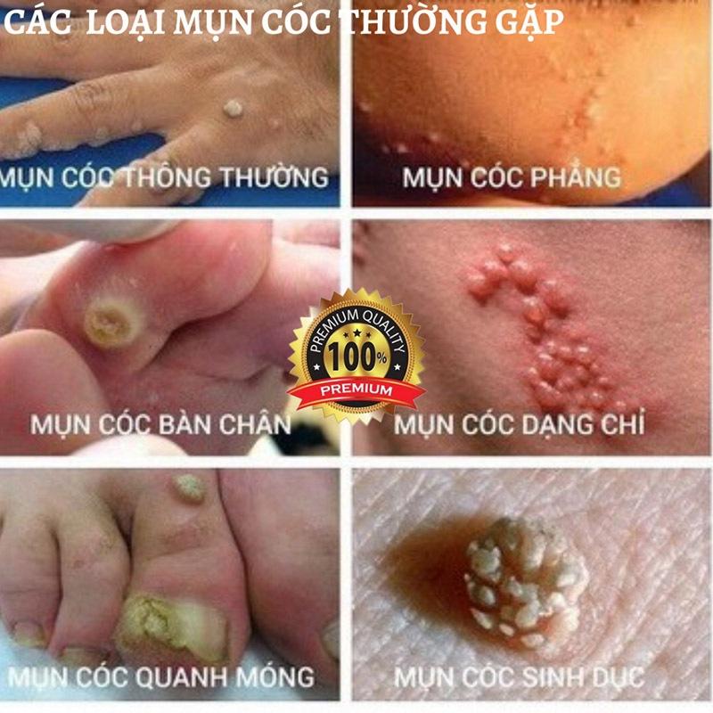 kem xoá mụn cóc,mụn thịt,loại bỏ mụn cóc thông thường,mụn đá,mụn cơm,mụn cóc dạng sợi 20g 3