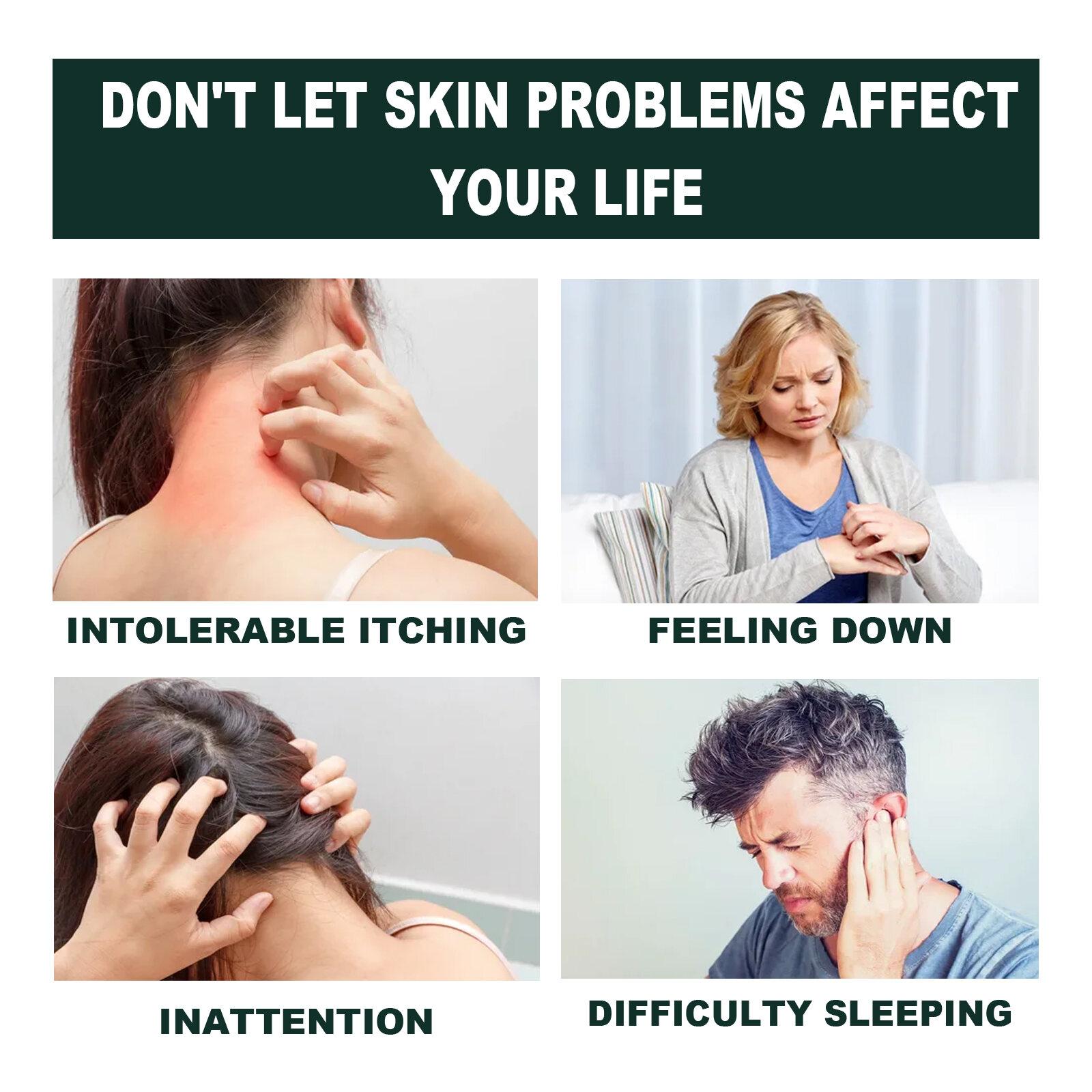 Salep Psoriasis Anti-Gatal South Moon Krim Perbaikan Psoriasis meredakan gatal Perbaikan Kulit