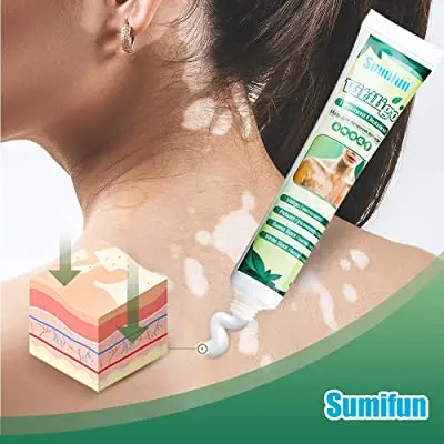 Obat Penghilang Vitiligo Salep Krim Vitiligo Kulit Bercak Belang Bintik Putih Paling Ampuh 20 gr Bebas Paraben 2