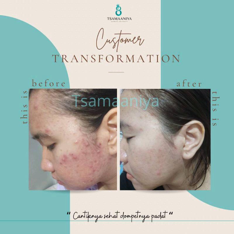 Tsamaaniya paket acne basic (untuk jerawat aktif) 6