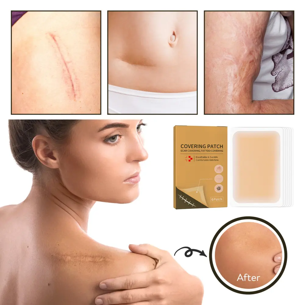 [cod] Jaysuing Concealer Patch Scar Burning Silicone Patch Skin Invisible Concealer Paste Sticker Breathable And Comfortable Skin Tone
