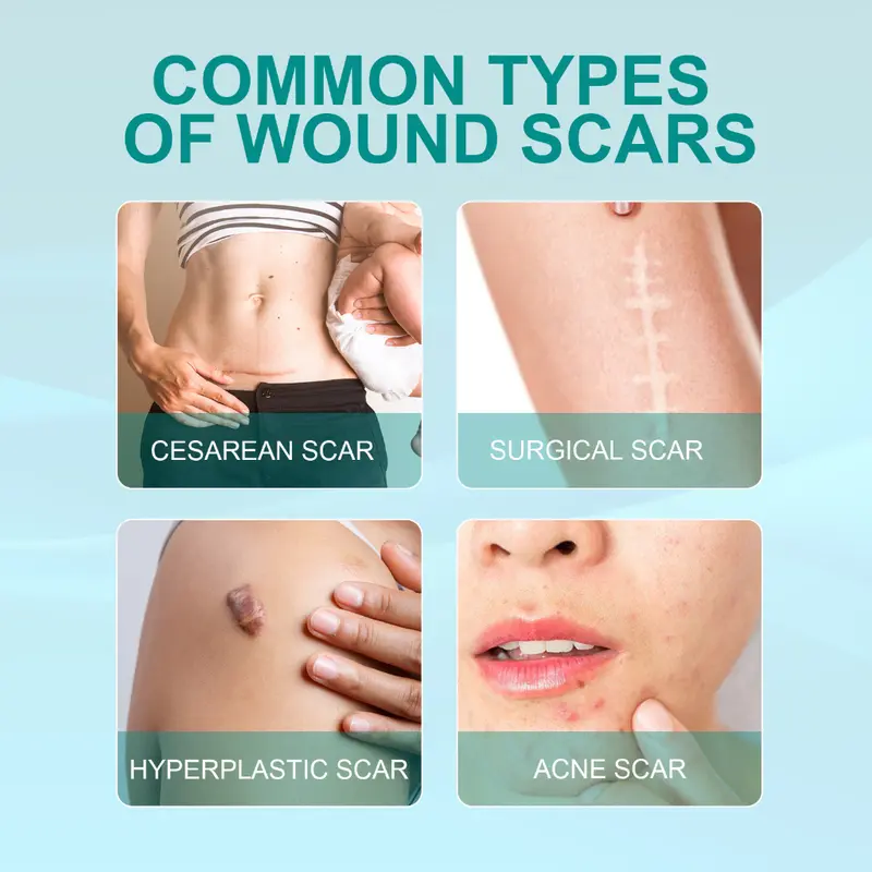 semprotan penghilang bekas luka scar remover spray removal repair skin care Acne Treatment Perawatan jerawat remove stretch marks Repair Burn Surgical Scar 4