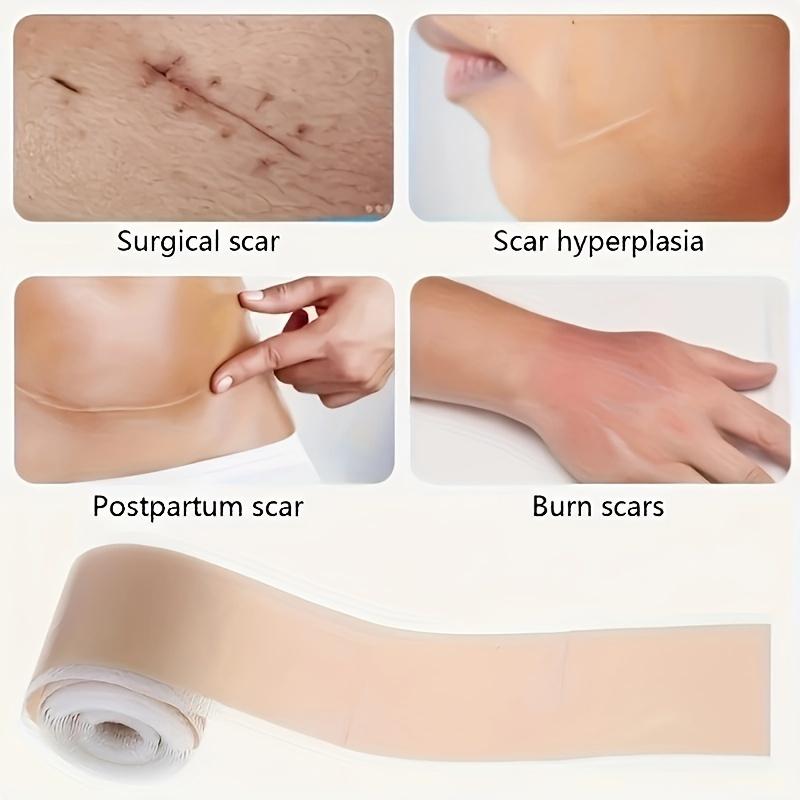 Product Introduction of Silicone Scar Tape Roll - 1.57inch x 59.06inch Invisible Scar Removal Patch, Silicone Gel Tape for Fading and Concealing Scars, Scar Cover Up Adhesive Tape for Surgical, Hyperplastic, Postpartum, and Burn Scars - 1 Rollc 5