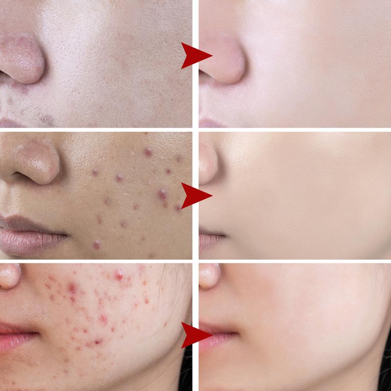 Kem Thu Nhỏ Lỗ Chân Lông Axit Salicylic, Xóa Mụn Nhanh Chóng, Loại Bỏ Lỗ Chân Lông Lớn, Loại Bỏ Mụn Đầu Đen, Làm Săn Chắc Da Mặt, Làm Mịn Da, Chăm Sóc Da, Sản Phẩm Mới 2024 5