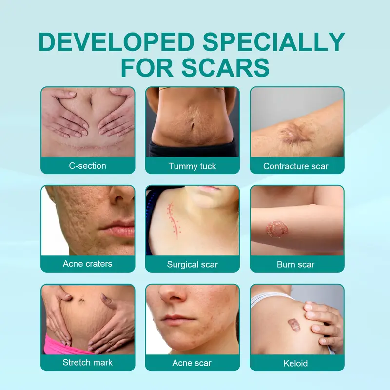 semprotan penghilang bekas luka scar remover spray removal repair skin care Acne Treatment Perawatan jerawat remove stretch marks Repair Burn Surgical Scar 1