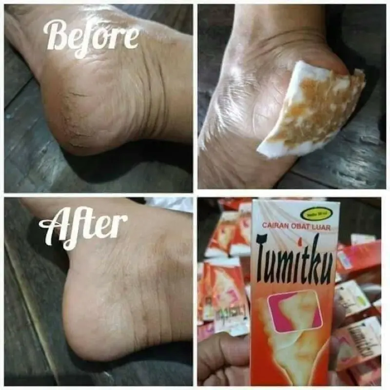 TUMITKU Obat Kaki Pecah Solusi Kaki Kapalan Kalus Pecah Kering 1