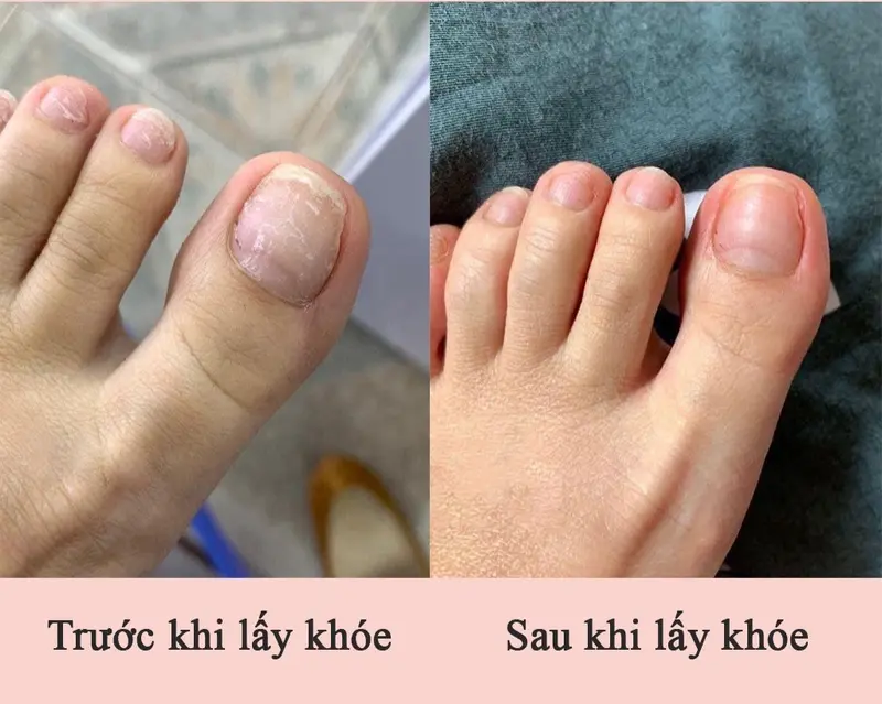 Cây khóe gỗ,cây lấy khóe m.óng cán gỗ 8