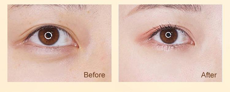 Dinkiss Eye Treatment Oil Improve Skin Radiance Reduce Wrinkles Relieve Puffiness