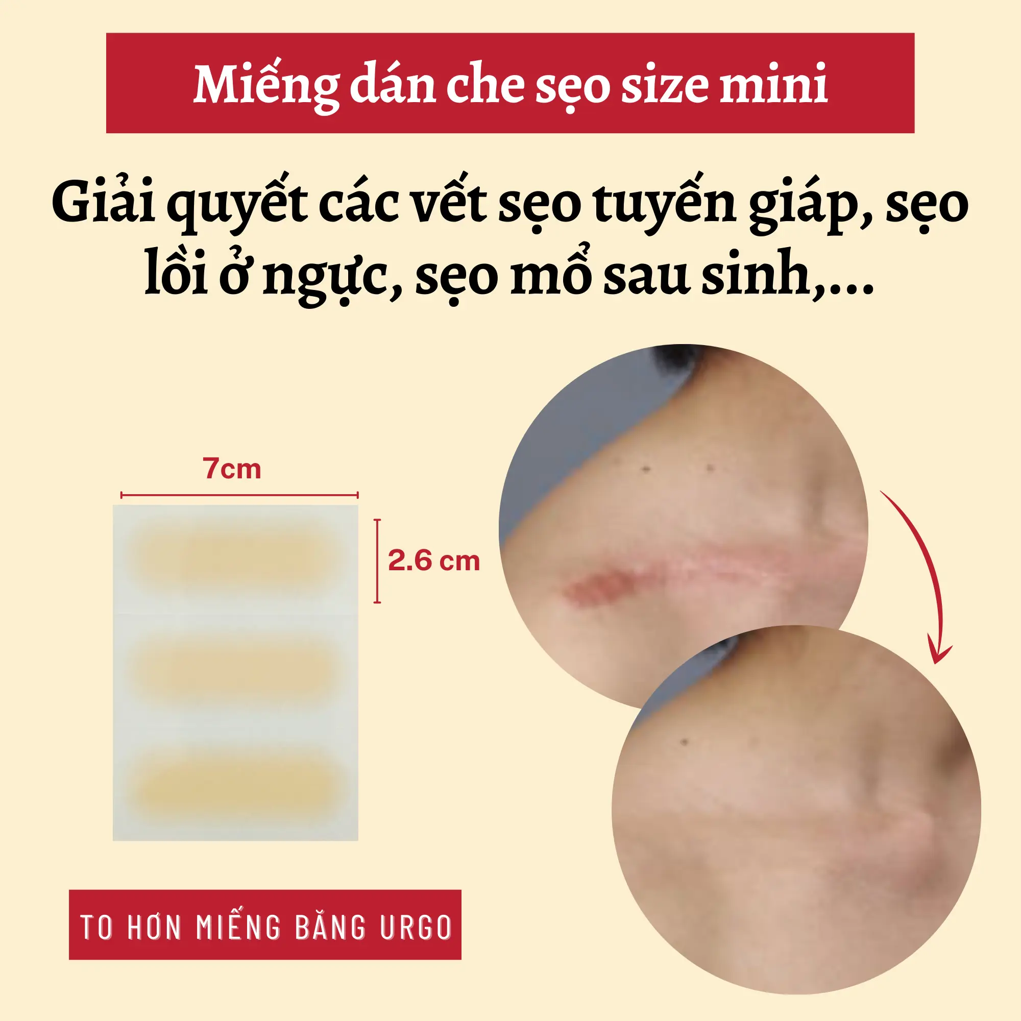 Miếng dán che sẹo tuyến giáp, sẹo phẫu thuật kích thước 2.6x7cm siêu mỏng, chống nước