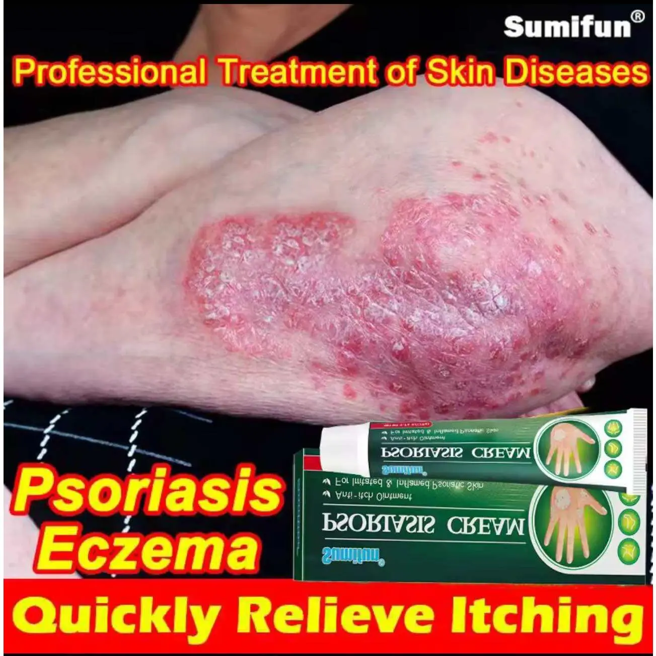 100% Effective Balat Ringworm Net Cream, Blackhead Remover Balat ...