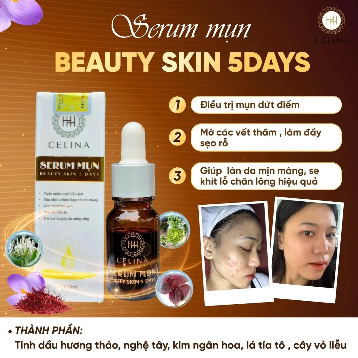 Serum mụn ngày beauty skin 5 day Celina