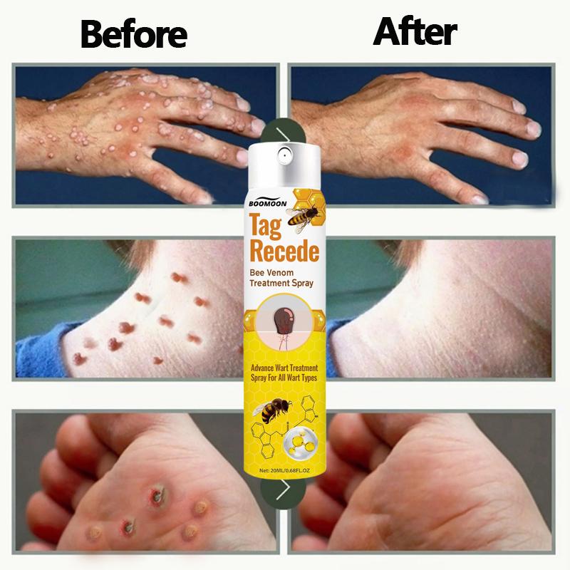 Penghilang Kutil Dan Tahi Lalat Obat Penghilang Kutil Penghilang Tahi Lalat Di Wajah Obat Kutil Ampuh Skin Tag Remover [S09]