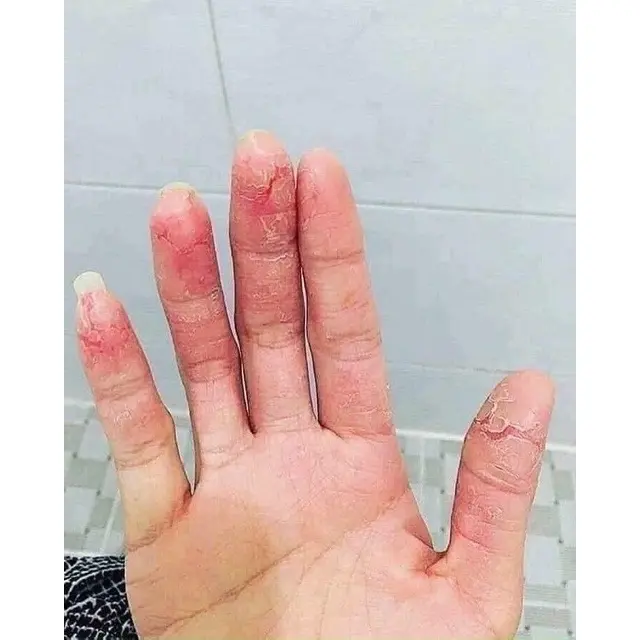 Kem bôi ngoài da clinoderm thái lan typ 15g 3