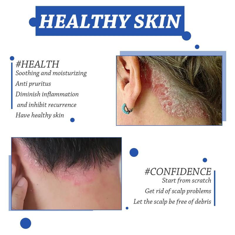 Product Introduction of Anti Dandruff Cream for Scalp Itching and Dandruff for Men & Women,anti Hair Loss Nourish Hair Fast Growth Cream,hair Treatments/Natural Cream for Psoriasi Eczma 20g 6