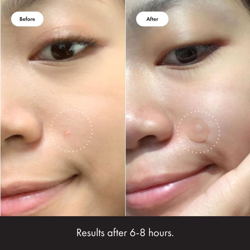 Product Introduction of [Spot Patch-120 miếng] Dán mụn giúp giảm sưng mụn Shupong Spotpatch dạng cuộn 13