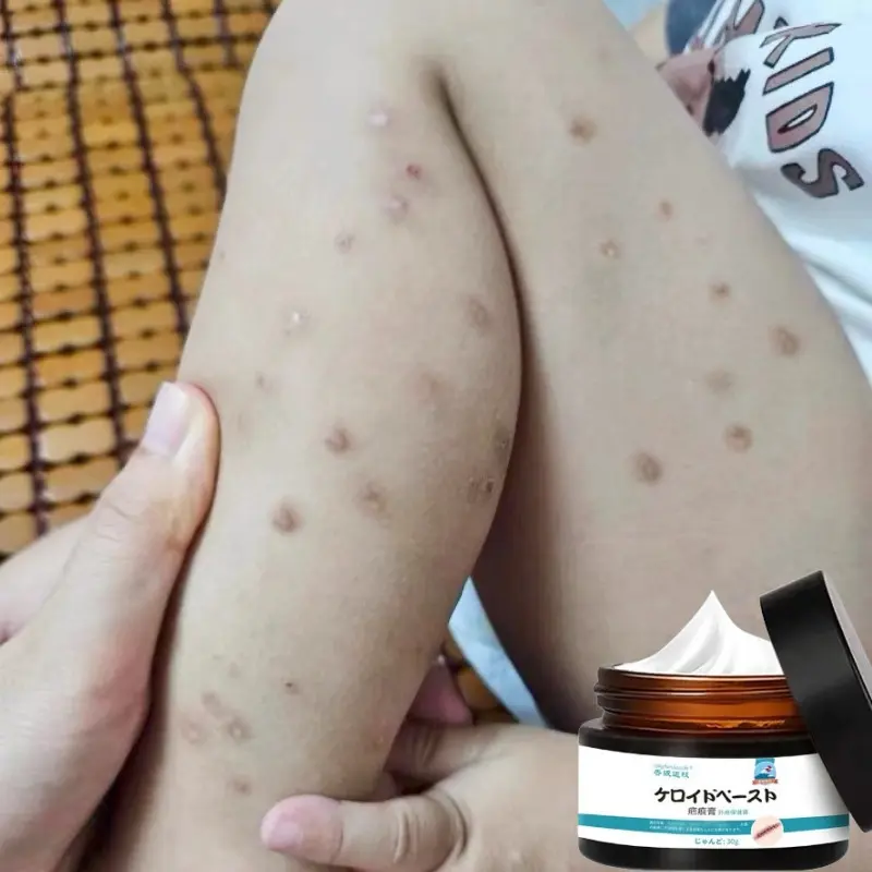 Salep Penghilang Bekas Luka Susu Tubuh Penghilang Bekas Luka Koreng Hitam Penghilang Bekas Luka Gigitan Nyamuk, Stretch Mark, Penghilang Bekas Luka Jahitan 1