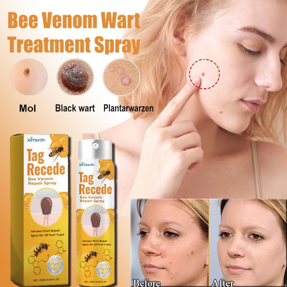 Penghilang Kutil Dan Tahi Lalat Obat Penghilang Kutil Penghilang Tahi Lalat Di Wajah Obat Kutil Ampuh Skin Tag Remover [S09]