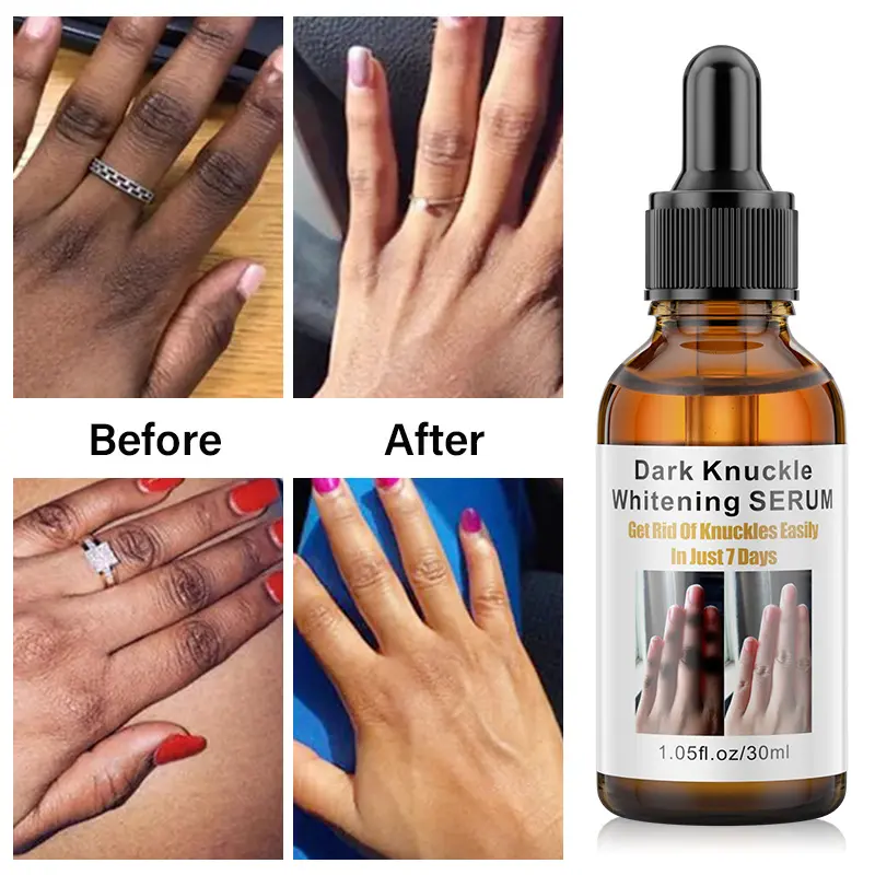 Knee and Ankle Joint Dark Spot Removal Essence, Finger and Elbow Brightening Serum Matte Fit SPF50 Sunscreen Serum simple  face  wash reti on l retino  leyecream Dokdo Round Lab Cleanser Centella Foam Ampoule Facial Cleanser barrier  cream lazy  cream