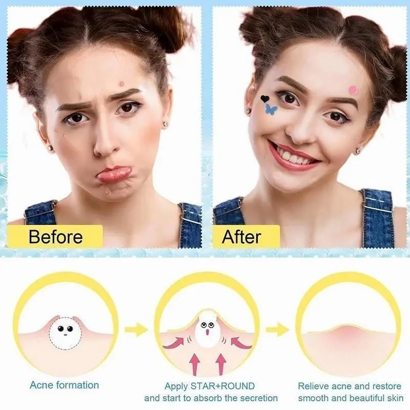 Acne patch lucu Pimple Patch Penghilang Jerawat Acnes Spot Care Plester Jerawat Acne Treatment 36 buah  stiker jerawat Cute Star/Heart Pimple Patch 4