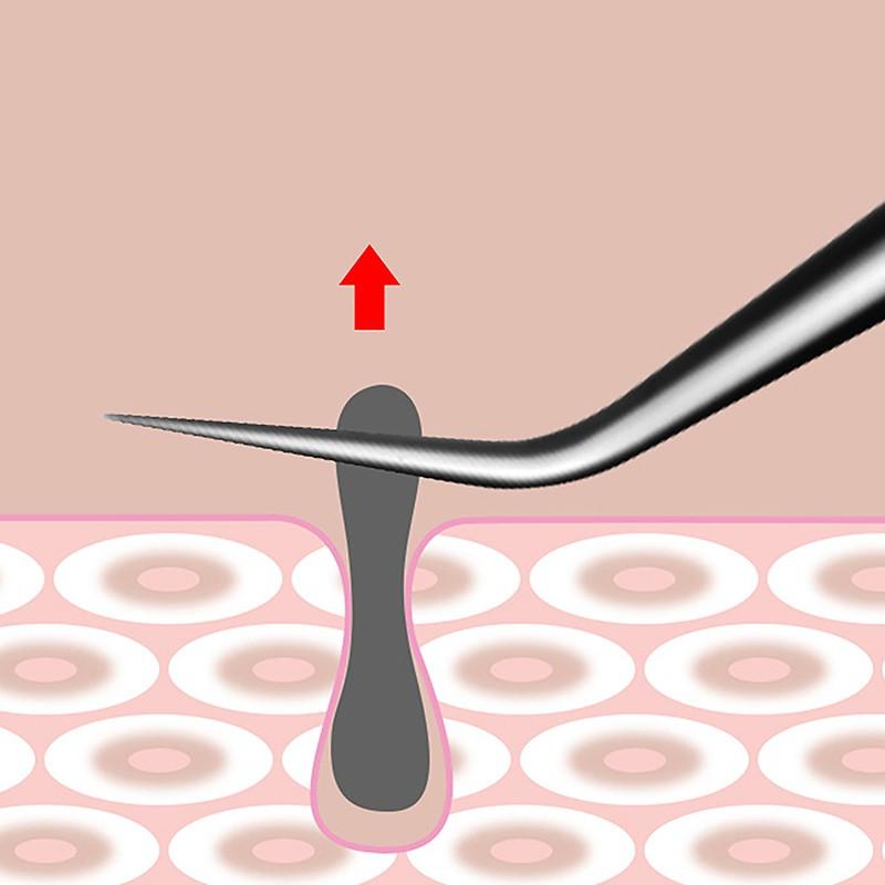 Nhíp Kẹp Mụn Trứng Cá Tế Bào, 8CM, Dụng Cụ Làm Đẹp, Chuyên Nghiệp, Chà Và Đóng, Dụng Cụ Trị Mụn, Đặc Biệt Cho Thẩm Mỹ Viện 3