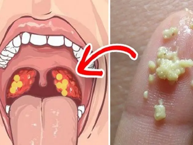 AMIDAN KHÔNG CÒN những cục BÃ ĐẬU, khoang họng sạch sẽ khi SÚC KHÒ HỌNG với TINH DẦU thảo dược với 5 BƯỚC đơn giản tại nhà