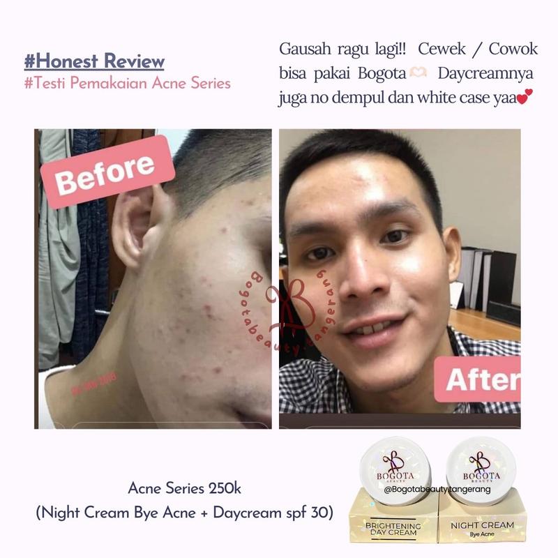 Bogota Beauty Skincare Bogota Normal Series Bogota Acne Series by Bogota Beauty Semua Jenis Kulit 3