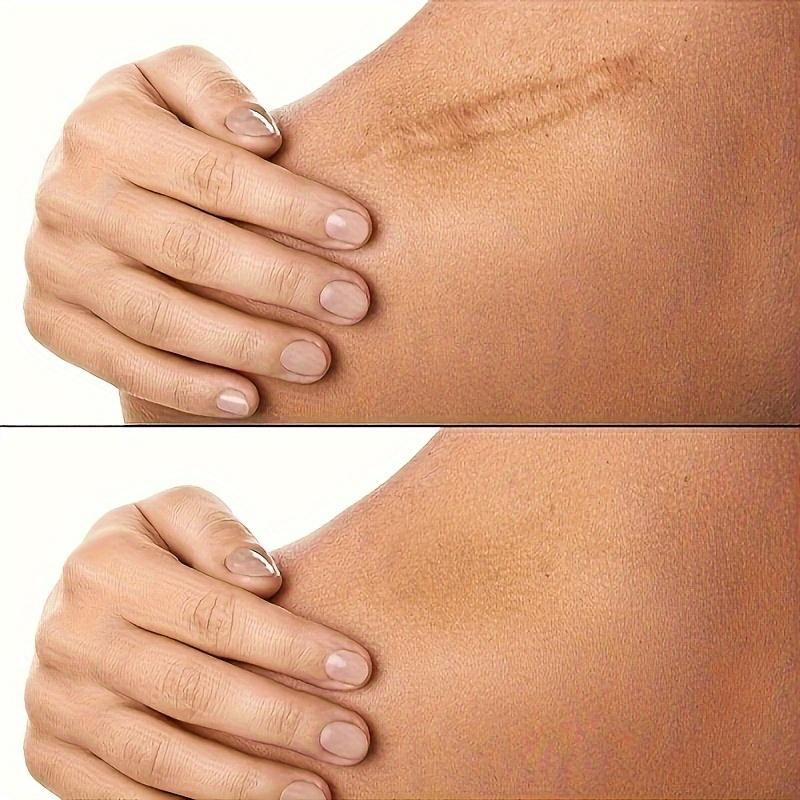 Product Introduction of Silicone Scar Tape Roll - 1.57inch x 59.06inch Invisible Scar Removal Patch, Silicone Gel Tape for Fading and Concealing Scars, Scar Cover Up Adhesive Tape for Surgical, Hyperplastic, Postpartum, and Burn Scars - 1 Rollc 7