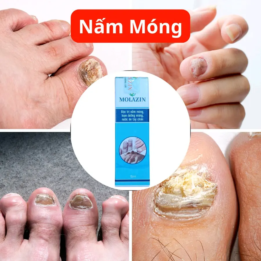 Nấm Móng Tay Chân,  Loạn Dưỡng Móng, Thối Móng Tay Chân Dứt Đỉm
