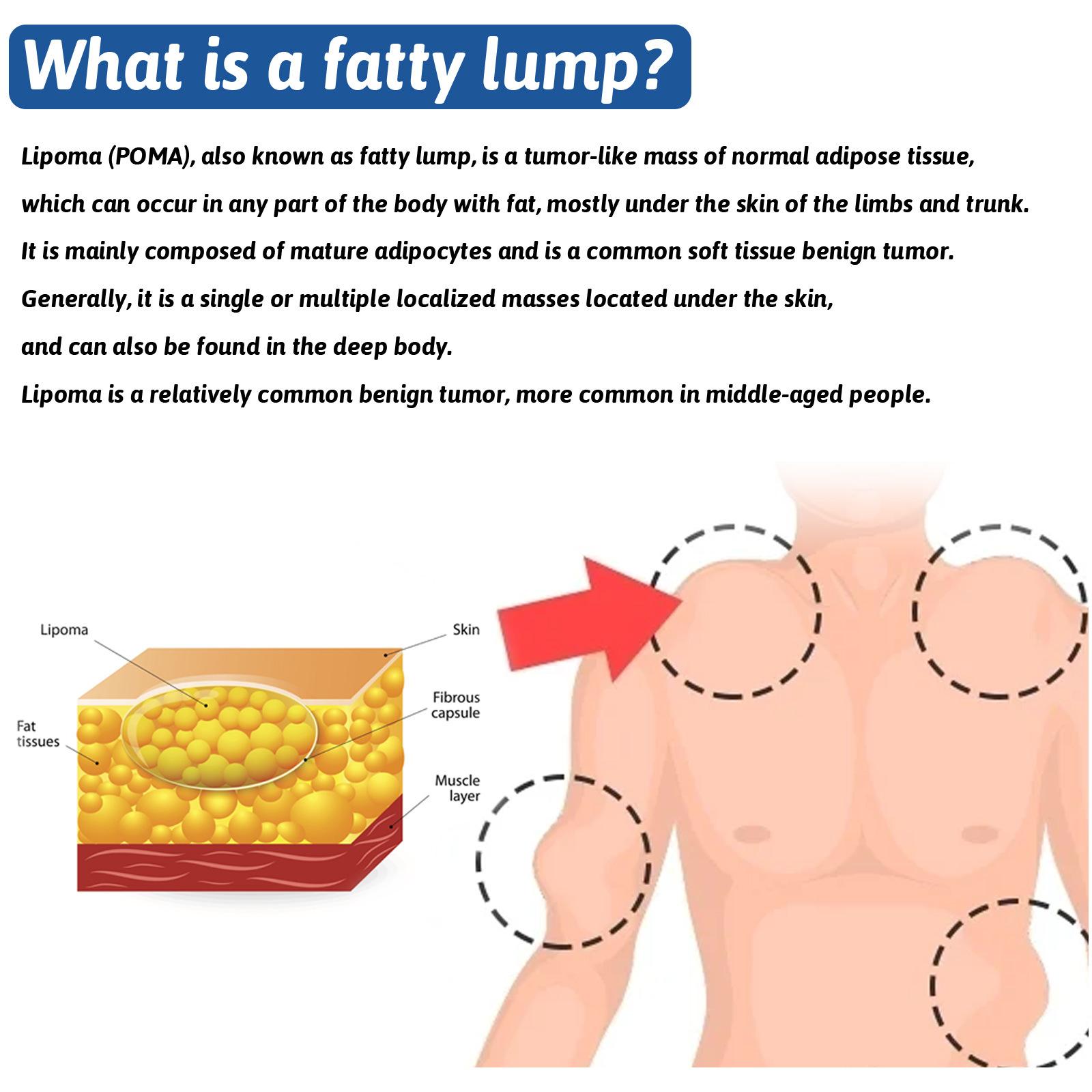 Salep Lipoma [IMPORT ASLI] Krim Lipoma Benjolan di Tubuh Penghancur Benjolan Kelenjar Getah Bening