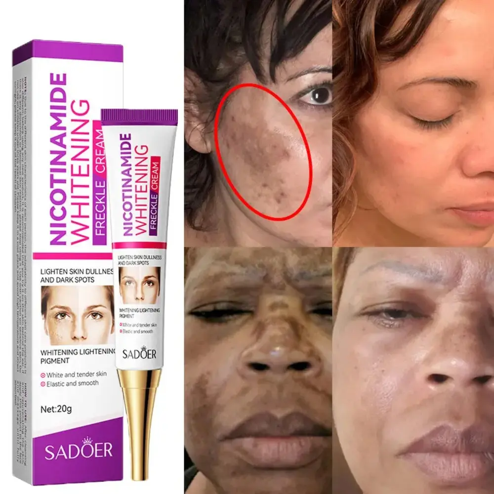 Effective Nicotinamide Whitening Cream Remove Melasma Brightening Freckles Cream Fade Color Spots Skin Hydration Moisturize Cream Face Skin