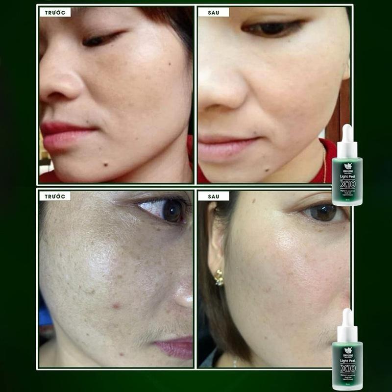 TÁI TẠO DA X10 Linh Hương ( Date 3 Năm hàng ch/hãng) 5