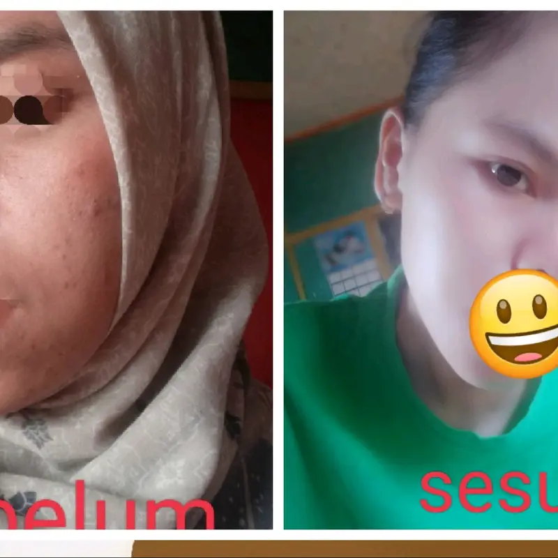 paket whitening kulit sensitif 3