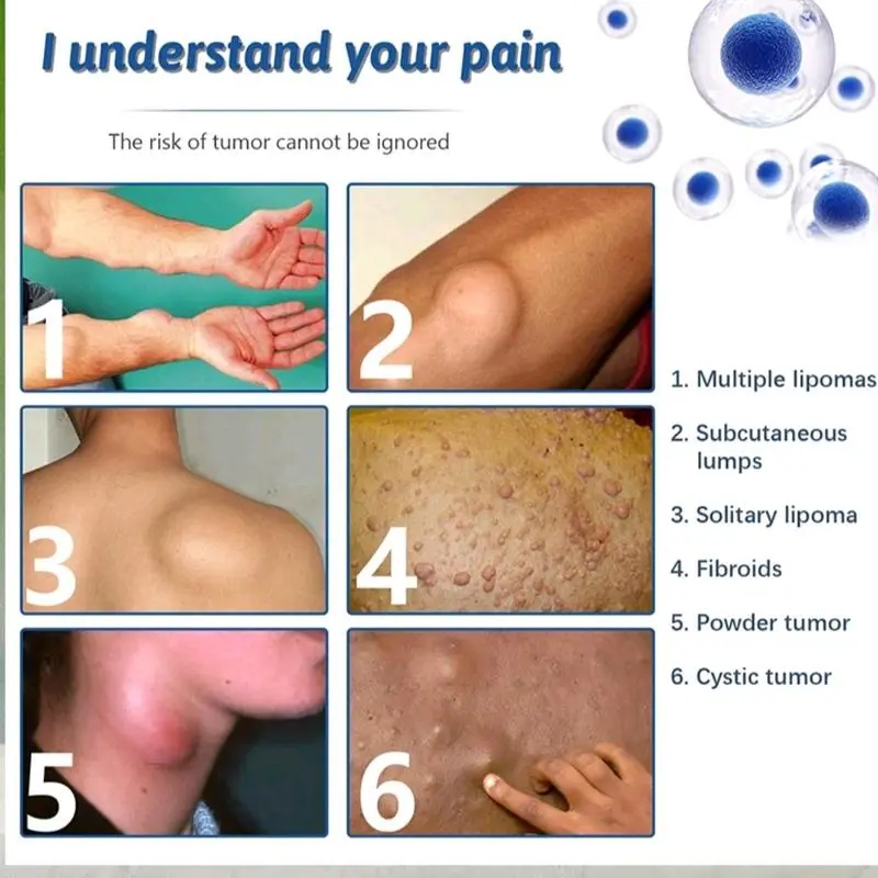 Lipoma Cream 20 gram Obat Lipoma untuk Benjolan di Leher, Tangan, Ketiak, Punggung, Pundak, Kaki, Selangkangan, dan Telinga - Tubuh, Hand 2