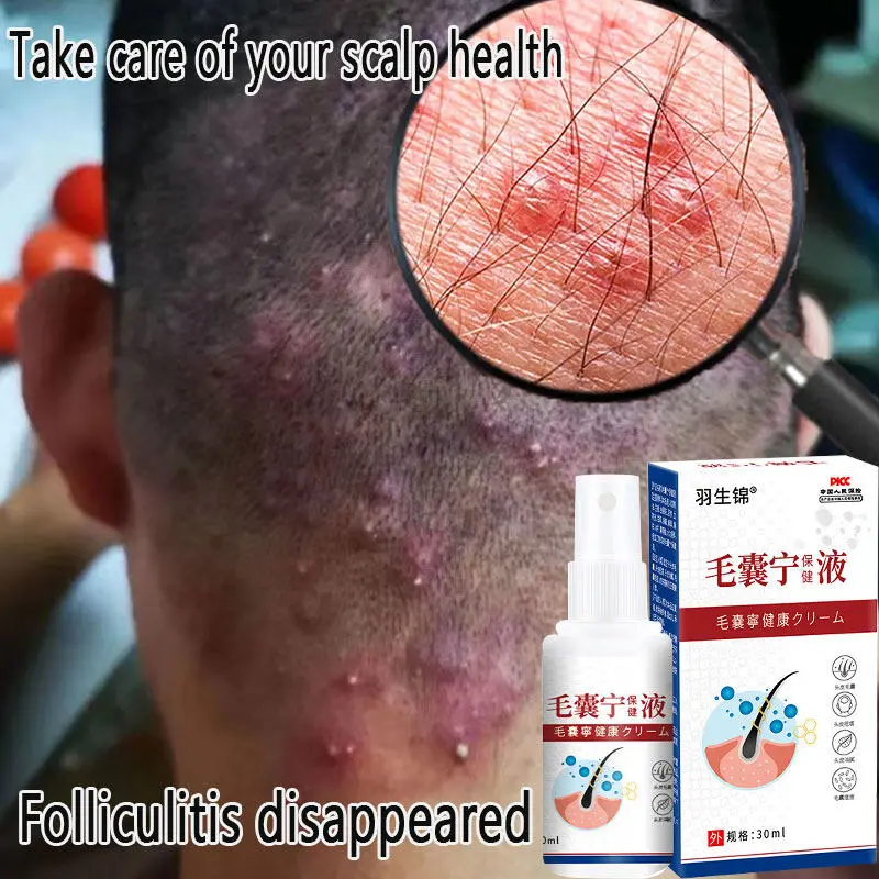 Scalp Treatment spray 30ml follicle nourishing essence for scalp folliculitis red and swollen acne seborrheic